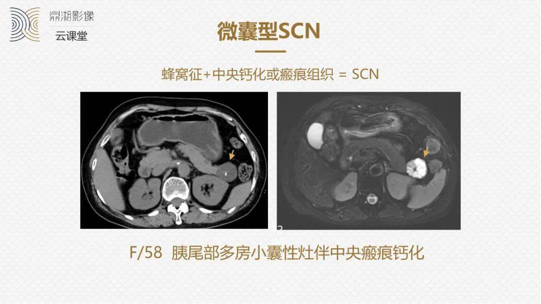 国人提出的囊外囊征象可以特异性诊断胰腺寡囊型浆液性囊腺瘤scn