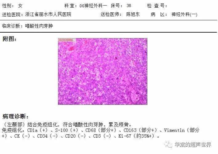 典型病例:颅骨嗜酸性肉芽肿(附:图钉征)