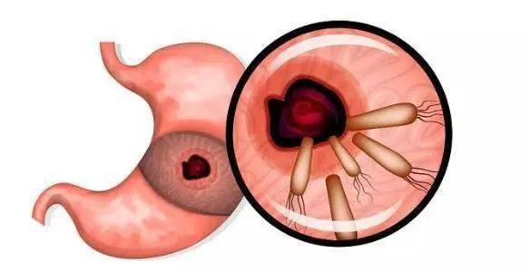 泉州年轻女孩恶心腹痛一查胃里竟长满鸡皮疙瘩