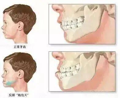 易造成上前牙前突,前牙深覆盖.