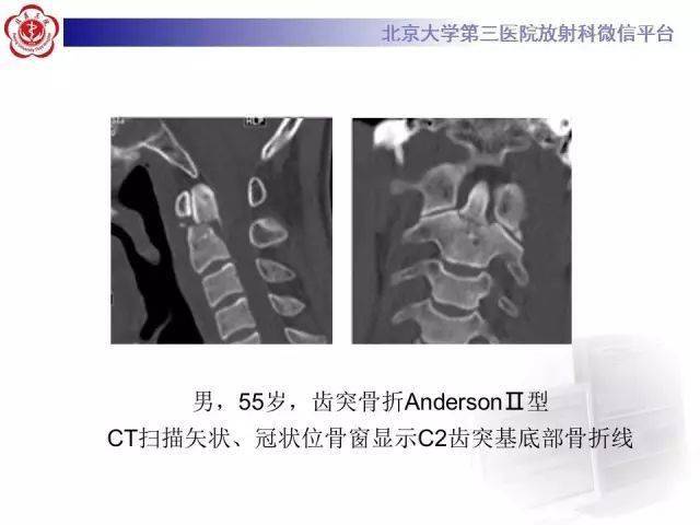 齿状突骨折分型