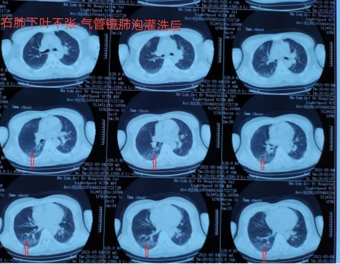 检查及镜下介入治疗,给长期卧床病人并发的痰多,坠积性肺炎带来了福音