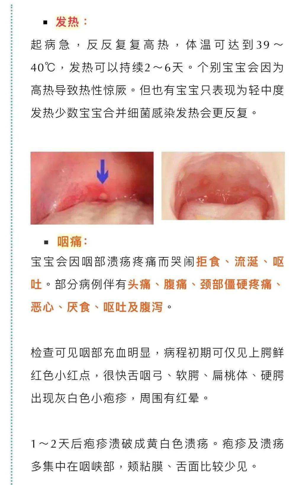 疱疹性咽峡炎有哪些症状什么是疱疹性咽峡炎它真有那么可怕吗?