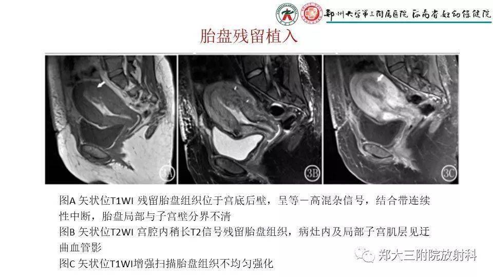 产后胎盘残留的mri影像表现_解剖图
