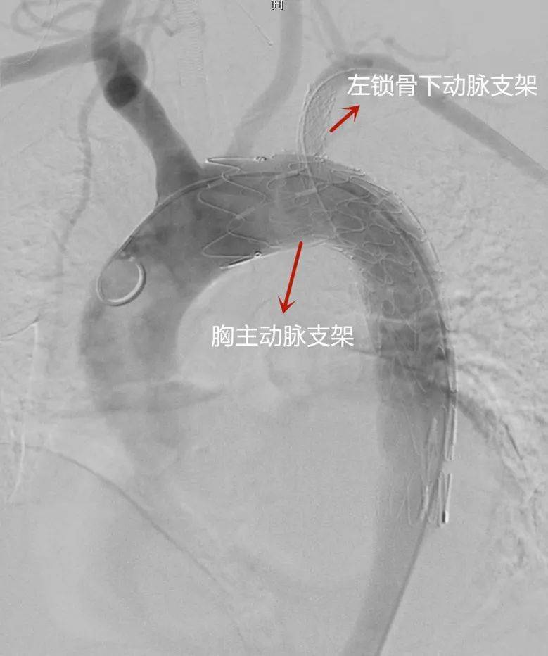 激光原位开窗术 清华长庚成功救治主动脉夹层患者_支架