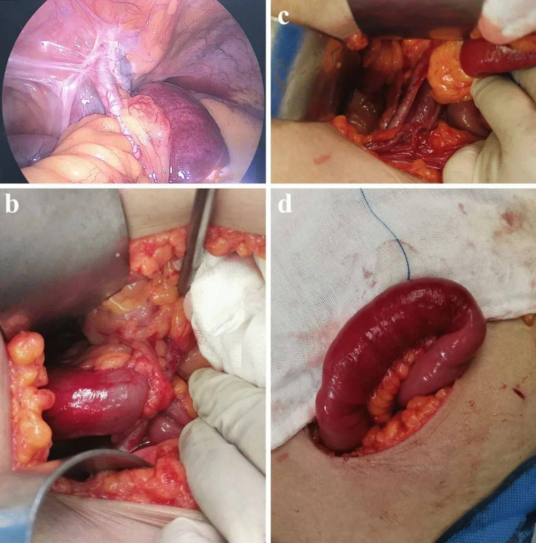 这例离奇的肠梗阻,起因却是9年前一次成功的手术