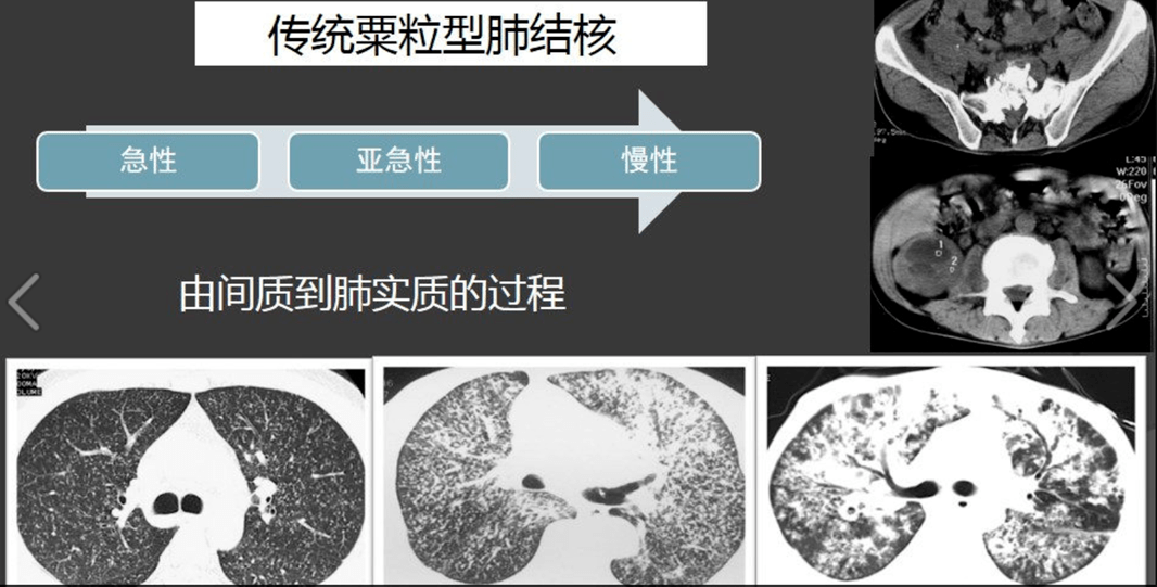 影像学:不典型表现(肺结核和covid19) 结核病人的ct演变过程