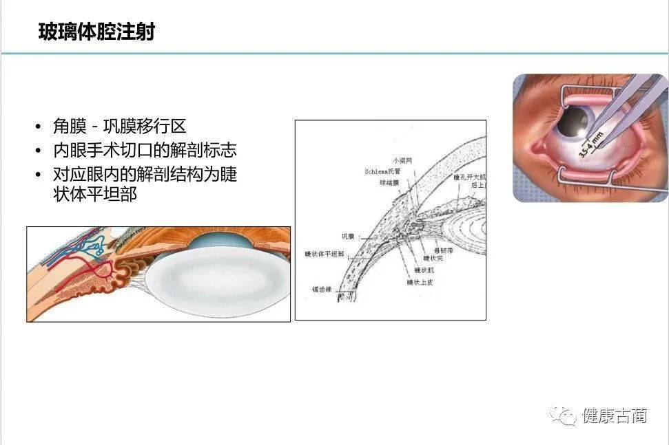 古蔺县人民医院成功开展全县首例玻璃体腔注药术开启眼底病治疗新篇章