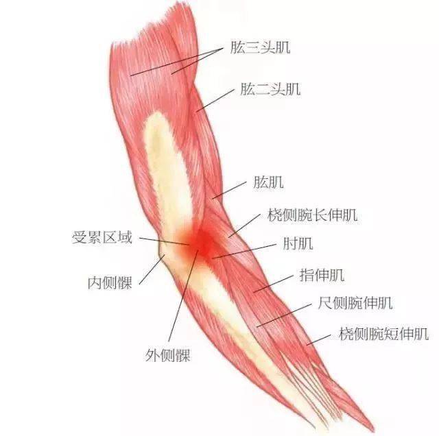 打乒乓球得网球肘咋办专业人士教您自我锻炼和康复方法