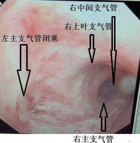 图13 气管镜检查
