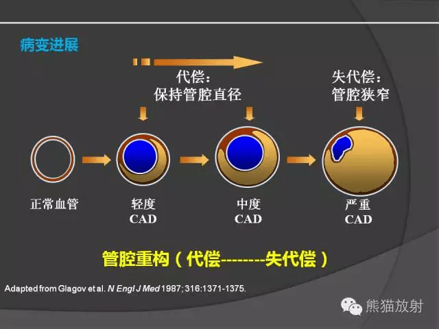 冠状动脉斑块评估管腔狭窄程度分级