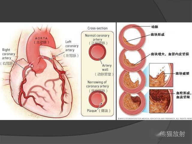 冠状动脉斑块评估管腔狭窄程度分级