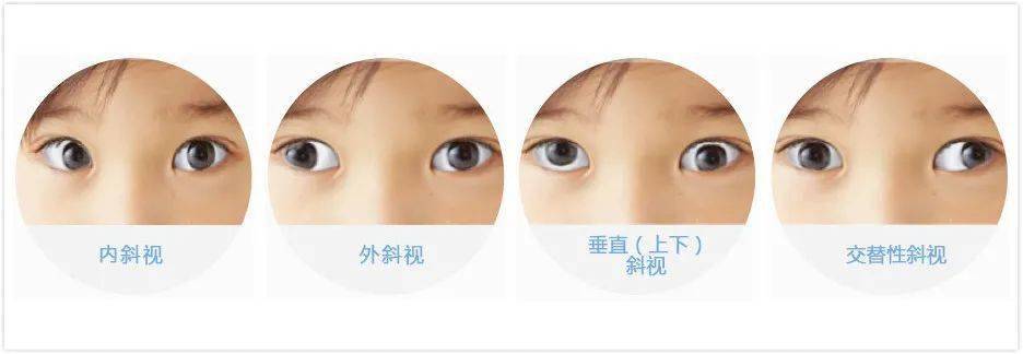 孩子斜视怎么办?北京专家让孩子重塑健康眼睛!