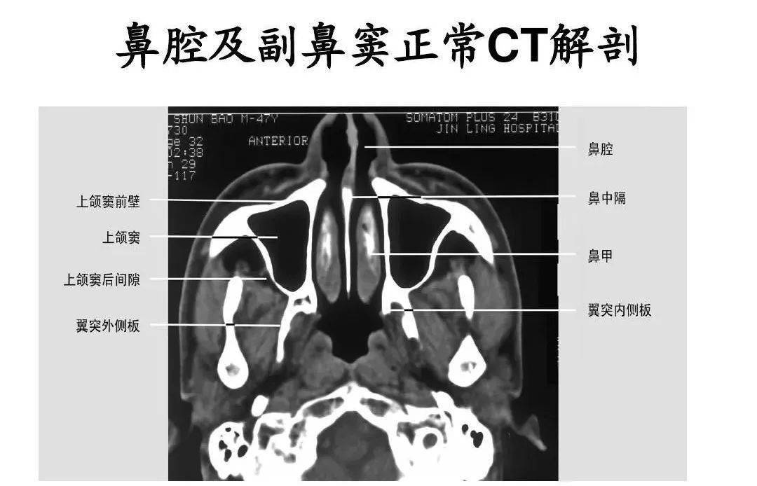 鼻及副鼻窦影像解剖