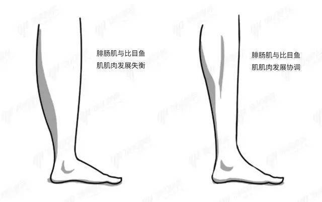 常见的小腿肥胖,也多属于这两块肌肉(腓肠肌,比目鱼肌肥胖)过度肥大