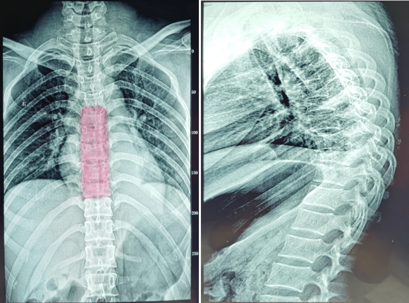影像学检查 胸椎正侧位x线:提示 胸   ,   骨折脱位,  胸