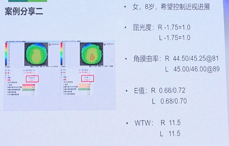 天津市眼科医院视光中心张姝贤主任myok角膜塑形镜的验配与案例