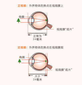 2岁男童近视700度,不可逆!只因家长一个坏习惯