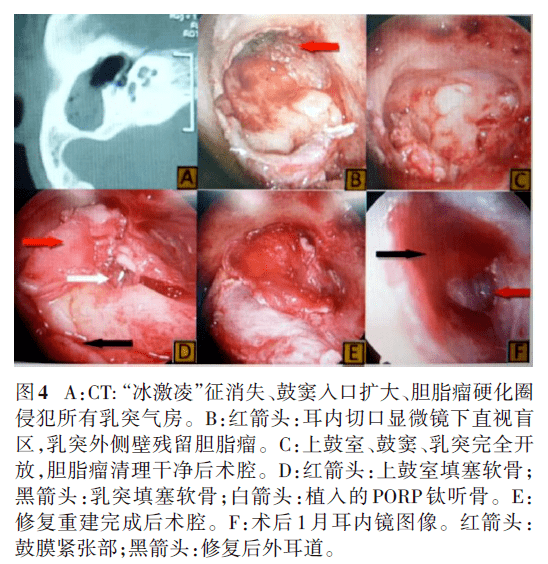 例2 男,40 岁,左中耳胆脂瘤,见图5.