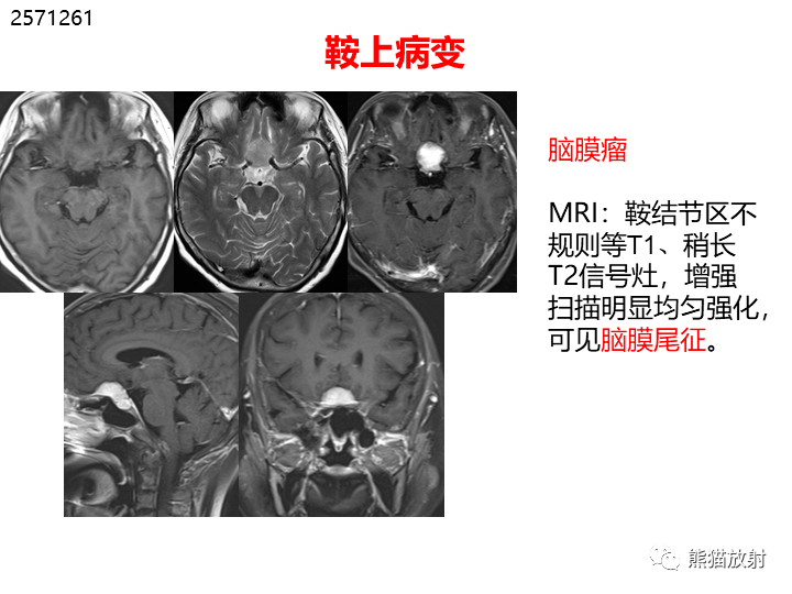 省立影像读片鞍区肿瘤2108