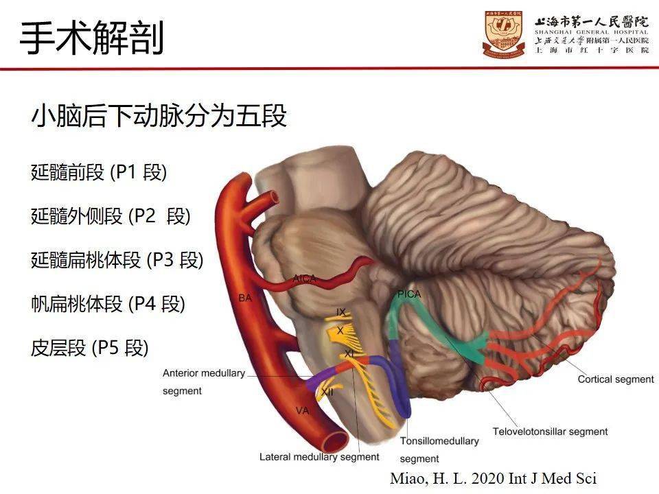 病例分享上海市第一人民医院苗宏生团队一例破裂小脑后下动脉瘤的手术