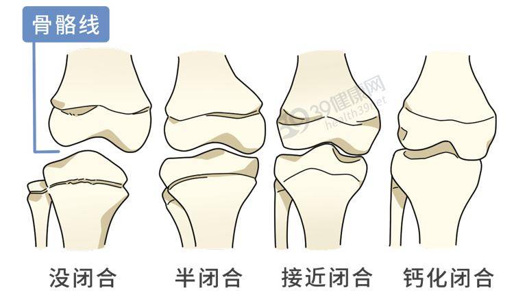 骨骼线有没有闭合  也是长高重要因素之一