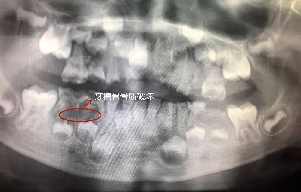 (红色区域为牙槽骨骨质破坏区)