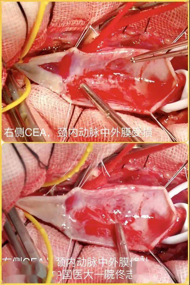 缝合悬吊颈动脉外膜4-6针(这样颈动脉的背侧面和颈动脉鞘连接在一起