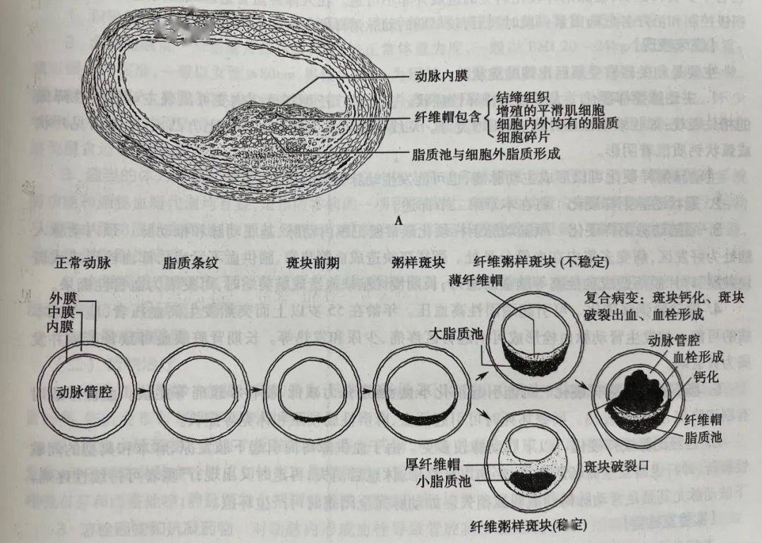 一文读懂 | 动脉硬化 vs 动脉粥样硬化