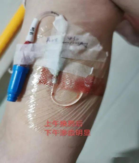 26行picc穿刺置管,穿刺点予无菌纱布覆盖,第二天因渗血较多,予更换
