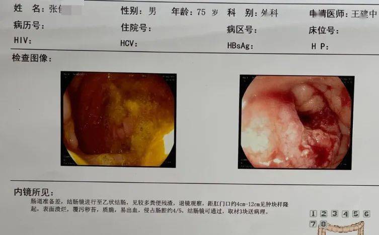 【同安一招鲜】七旬老人罹患结直肠癌,同安腔镜微创解除病痛