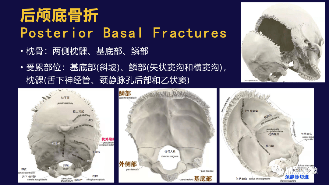 鼎湖精品 | 颅底骨折的分类及相关并发症