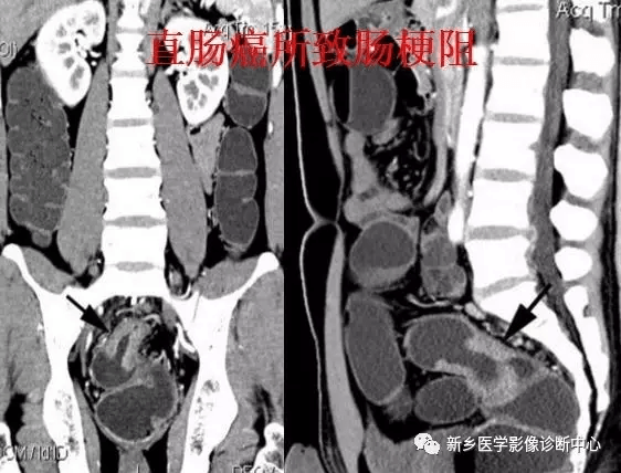 肠梗阻:中腹部多发阶梯状,马蹄状液平.2.空肠不全性梗阻.