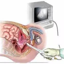 肛管|看屁股要做Ｂ超吗？细说直肠腔内超声的那些事！