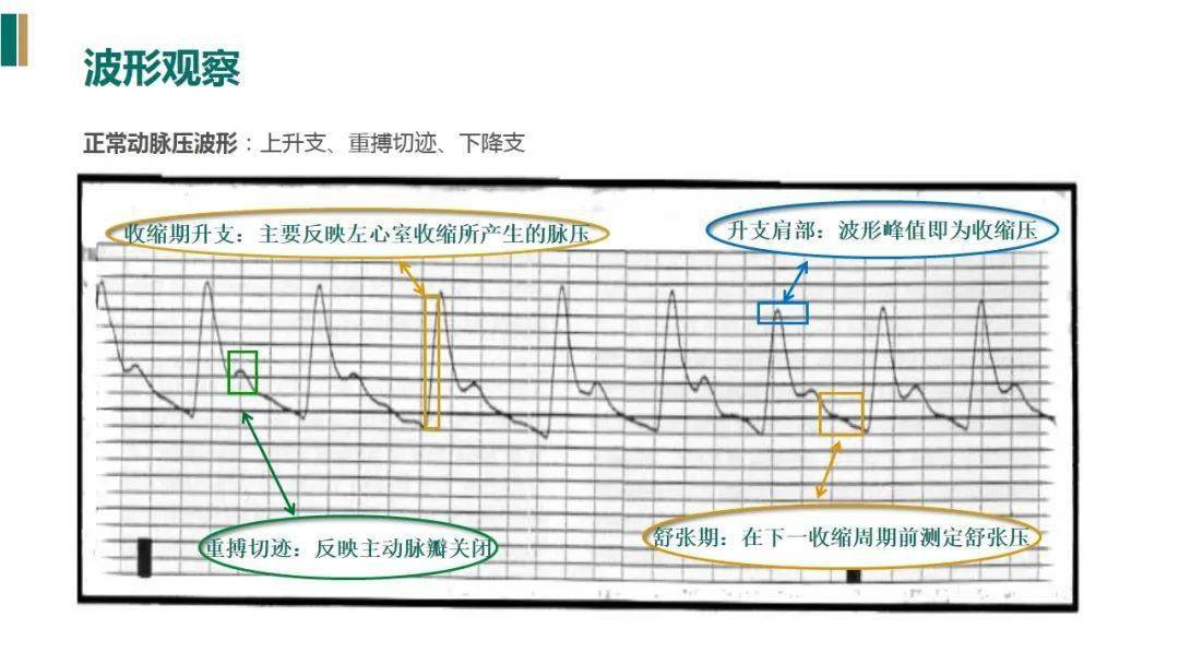 【ppt】有创动脉血压监测的护理(附具体操作精彩视频)