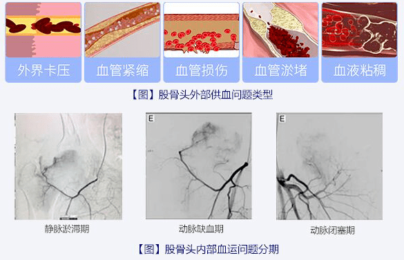 【专业解读】为何说恢复股骨头根源供血不是简单的事?