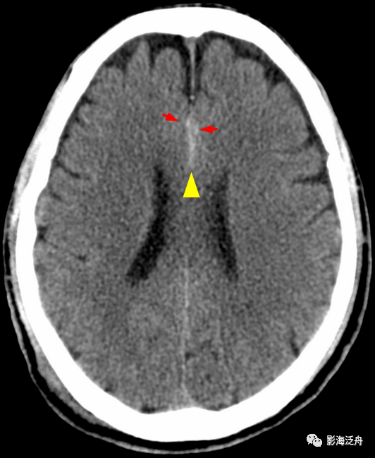 大脑镰旁急性硬膜下血肿与蛛网膜下腔出血的鉴别