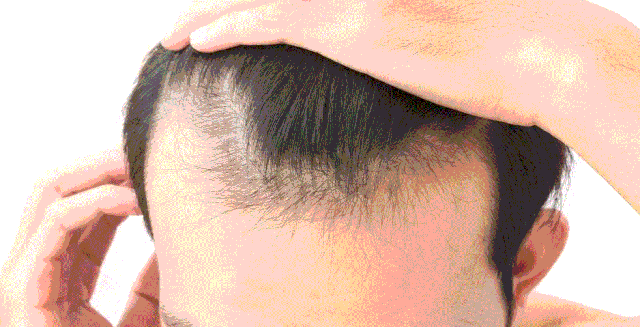 魔鬼生发液来了!4周让头皮