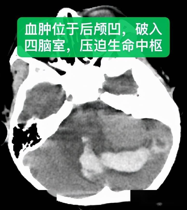4岁小儿突发脑出血生命垂危 武汉大学人民医院多学科携手救治创造生命