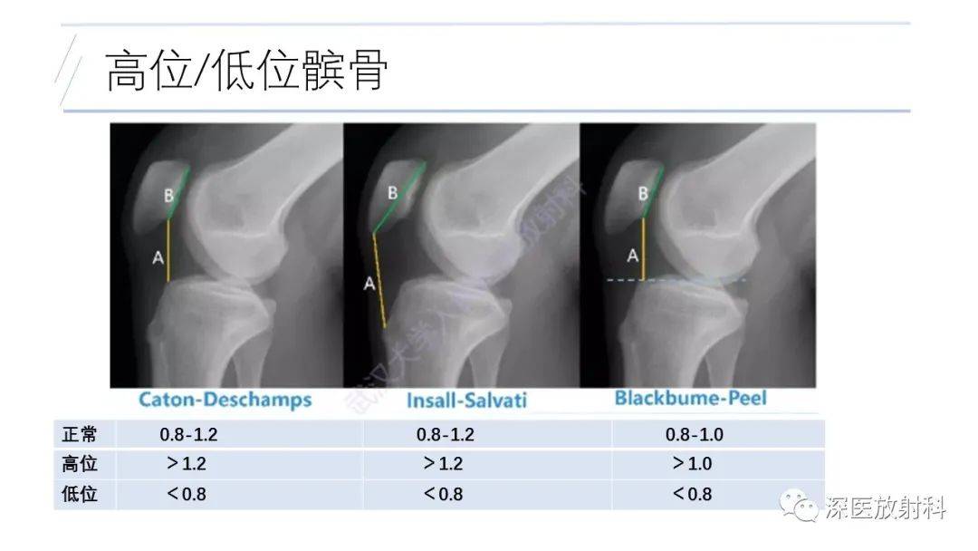 膝关节解剖变异的影像诊断