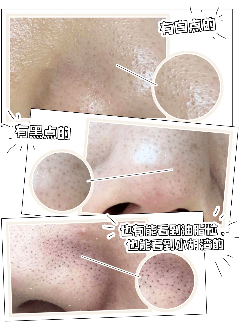 黑头1挤1个洞教你一招10年黑头不用挤鼻子滑溜到男朋友都想蹭