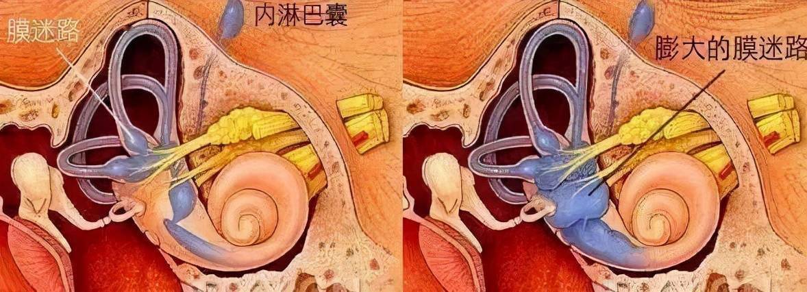 其发病机制尚不明确,主要的病理改变为膜迷路积水,从而呈现一系列前庭