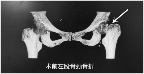 【前沿技术】挑战手术"禁区",95岁股骨颈骨折高龄老人重获新生