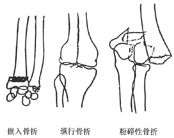 资源汇总丨急诊影像,实战病例 撕脱或劈裂骨折;螺旋形骨折 动脉瘤样