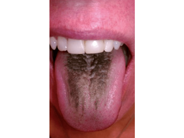 舌苔发黑是怎么回事?看看你是不是黑毛舌