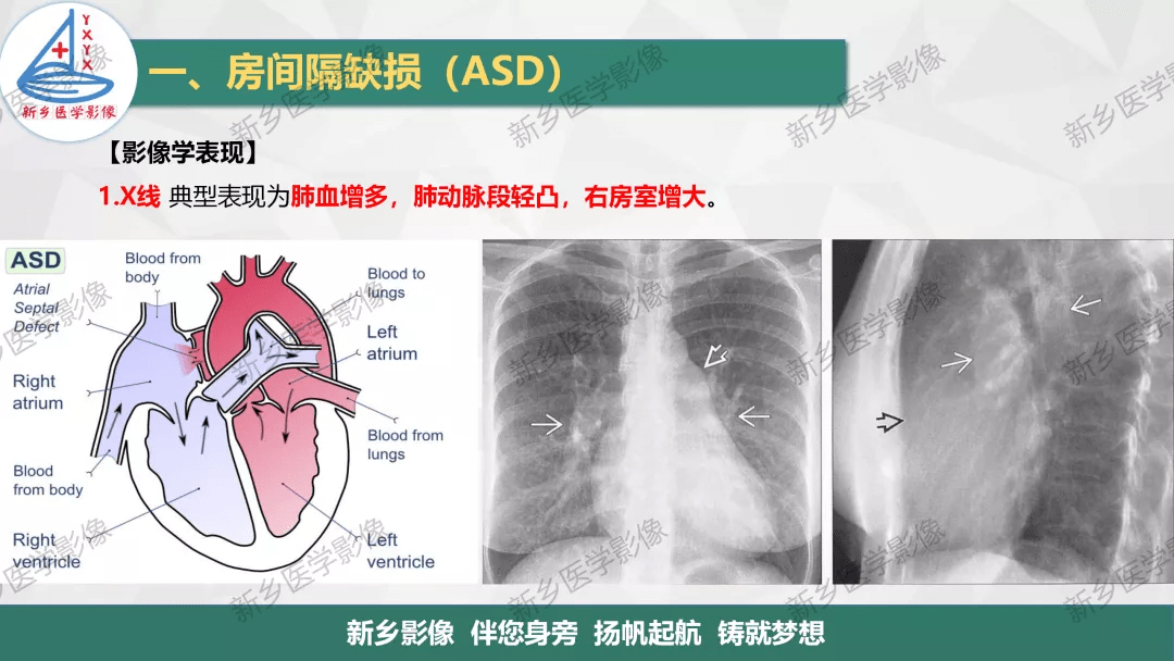 「一图明白」房缺,室缺,动脉导管未闭如何分型?