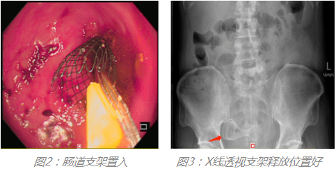 肠道支架打通肠癌患者生命通道