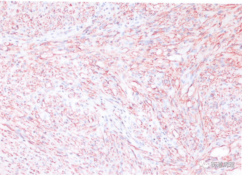 衡道丨干货卡波西肉瘤梭形的血管内皮细胞与hhv8感染密切相关