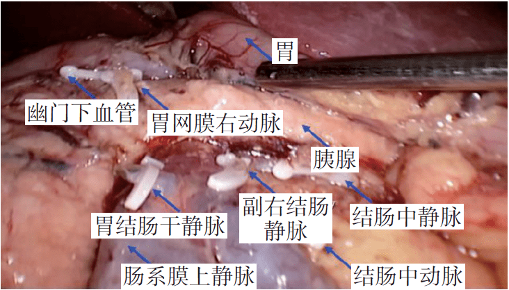 《腹腔镜胃肠手术笔记(第二版》新书抢先看_静脉