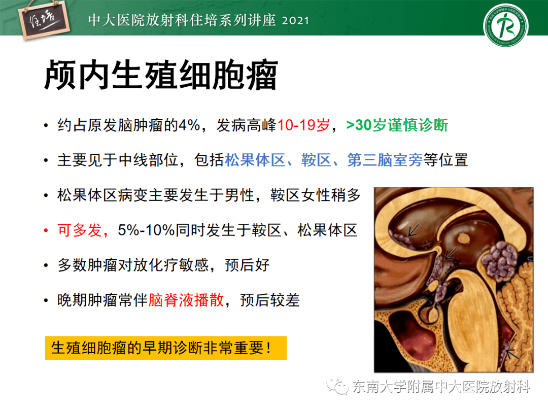 生殖细胞肿瘤 来自搜狐网